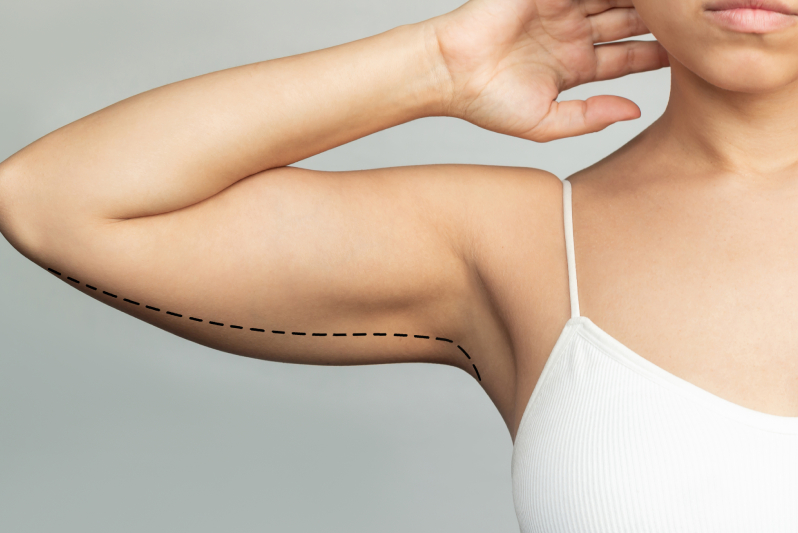 Why Choose This Upper Arm Fat Treatment?