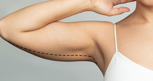 Upper Arm Fat Reduction