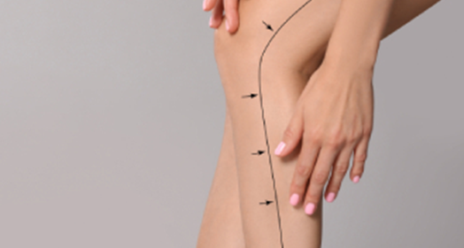 Leg Fat Reduction