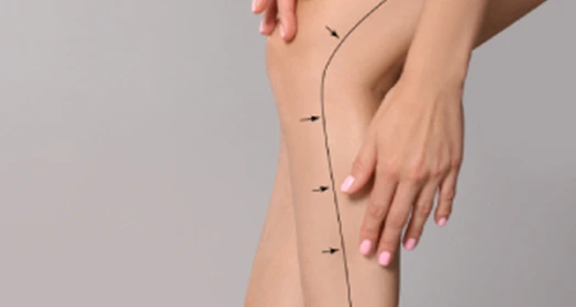 Leg Fat Reduction